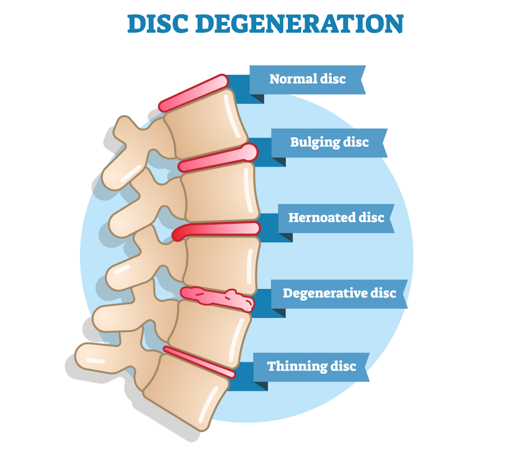 Herniated Disc: Causes, Symptoms & Treatment