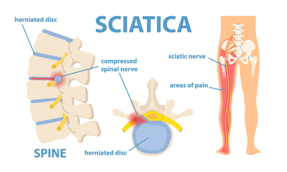 Diagram explaining sciatica pain.