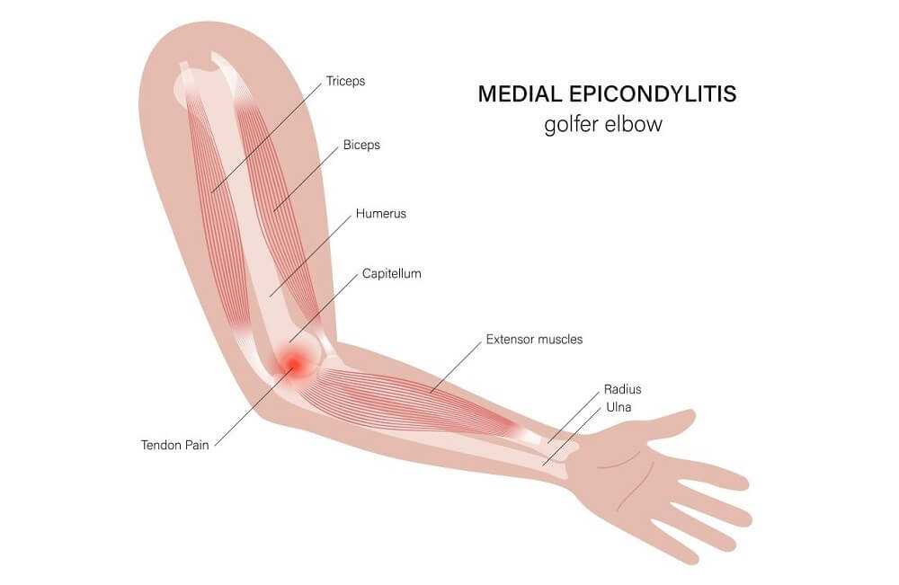 Illustration of golfers elbow pain.
