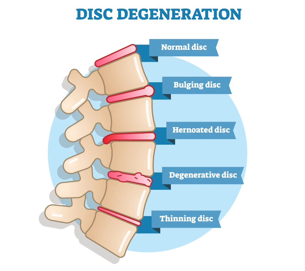 Disc degeneration illustration.