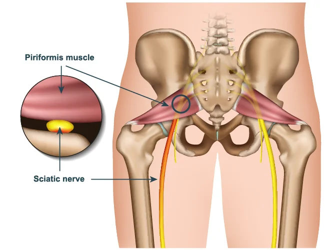 Diagram explaining piriformis syndrome.