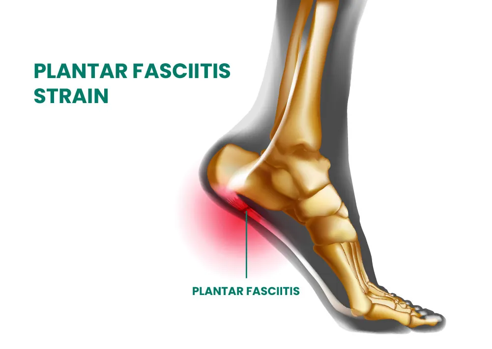 Plantar fasciitis diagram.