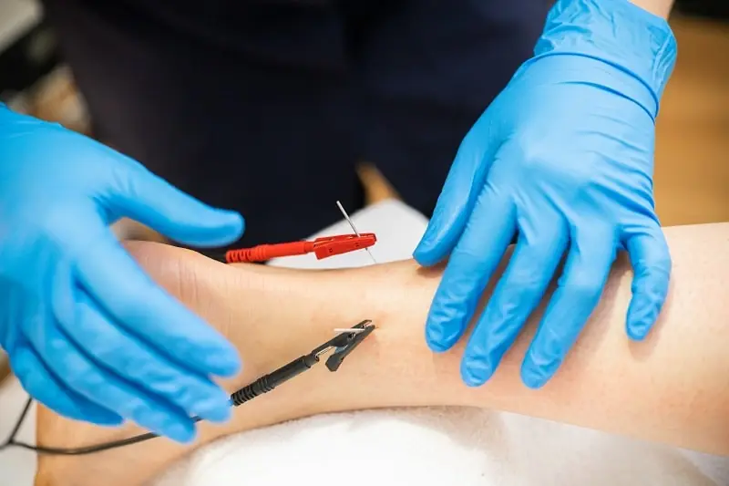 Physical therapist performing dry needling on patients leg.